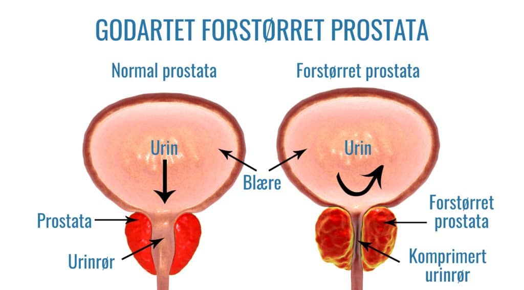 Normal prostata og forstørret prostata